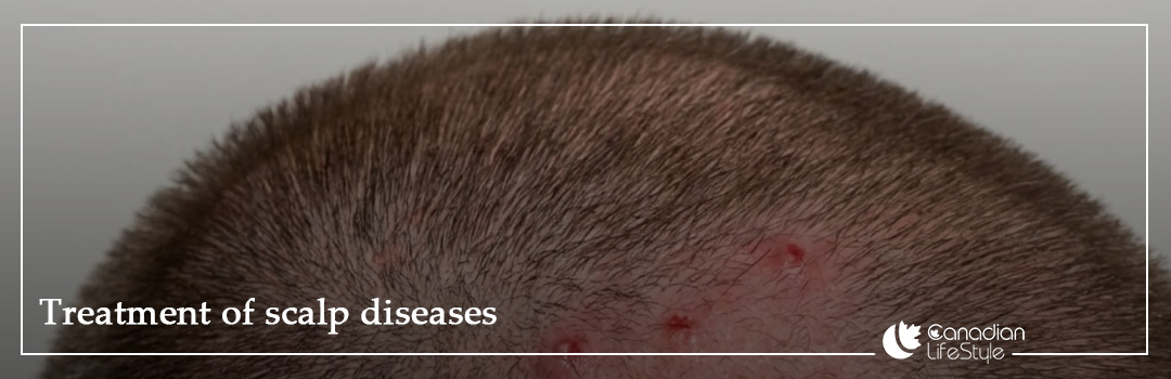 Treatment of scalp diseases