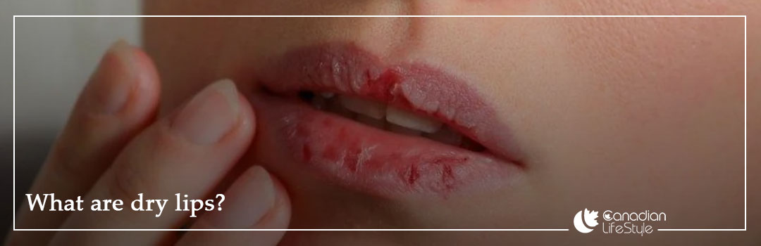 What are dry lips?