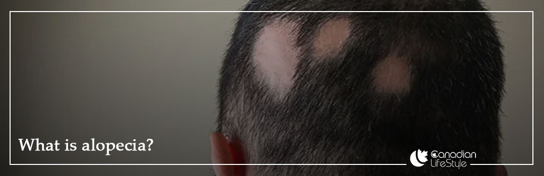 What is alopecia?