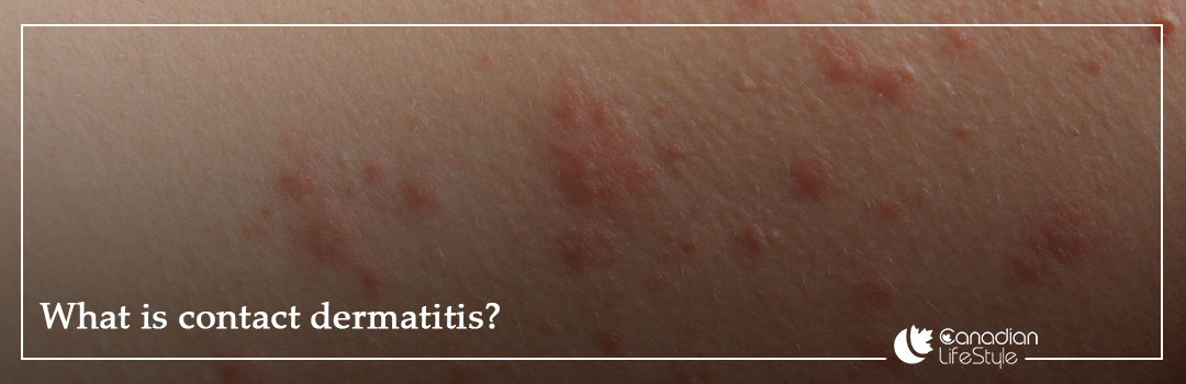 What is contact dermatitis?