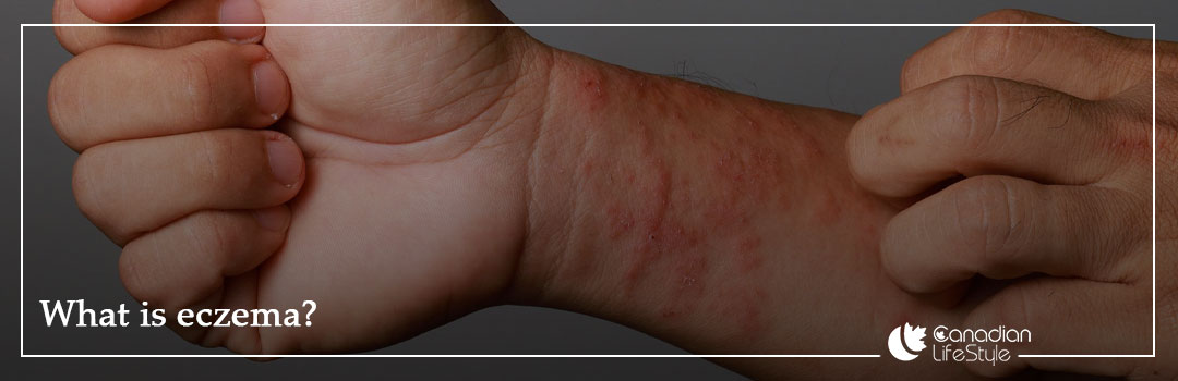 What is eczema?