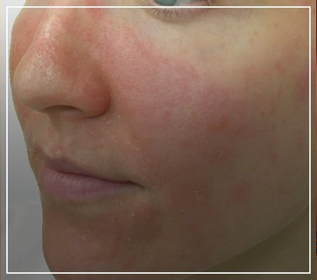 The Essential Guide to Understanding, Treating, and Calming eczema