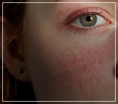 Rosacea: Causes, Symptoms, and Effective Treatment Options