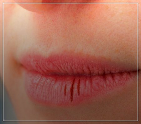 The Ultimate Guide to Dry Lips Treatment & Prevention
