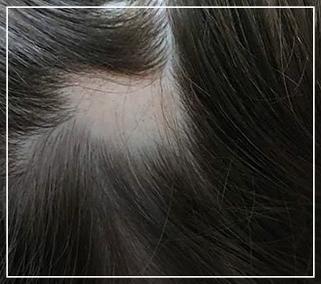 Guide to Alopecia Causes, Types, and Treatments