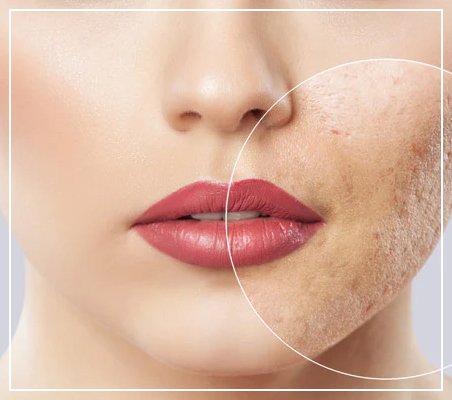 best treatment for blemishes on face