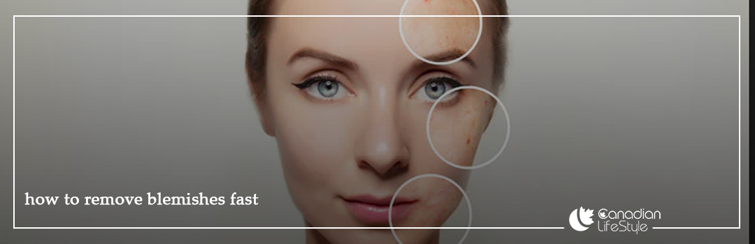 Treatment of Facial Blemishes