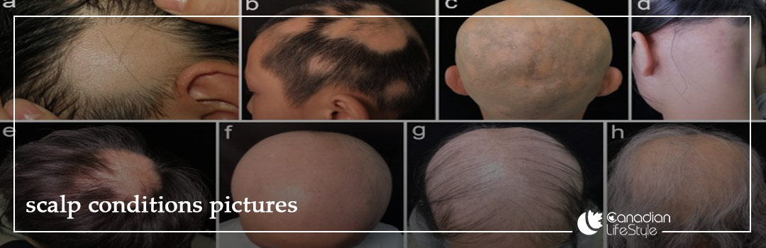 scalp conditions pictures
